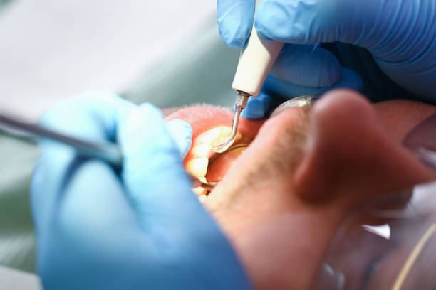 Best Emergency Root Canal Therapy in Johnston, IA